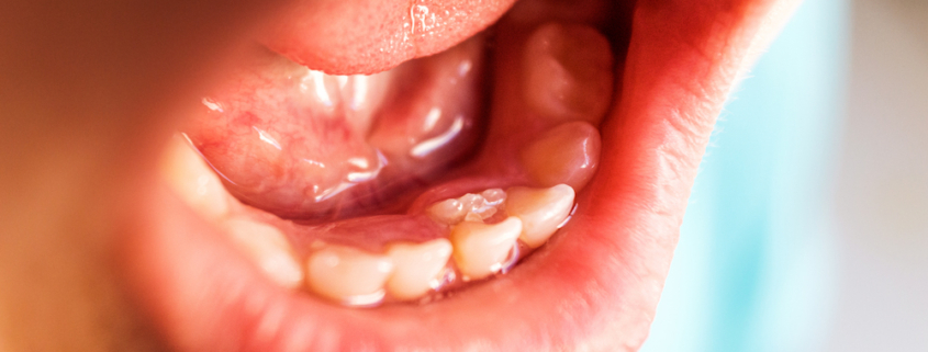 Dientes definitivos